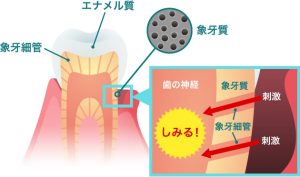 大丈夫ですか？知覚過敏