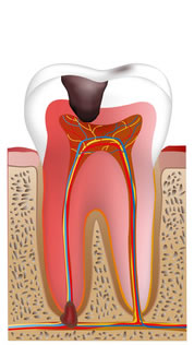 神経まで進行した歯