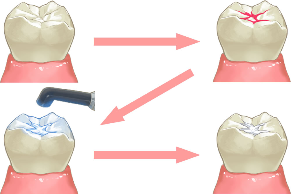 シーラントで虫歯予防