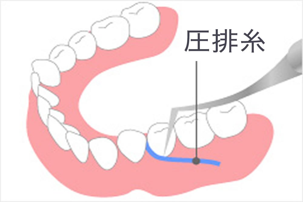 歯肉圧排で適合性向上