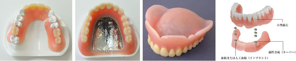 幅広い入れ歯の選択肢をご用意