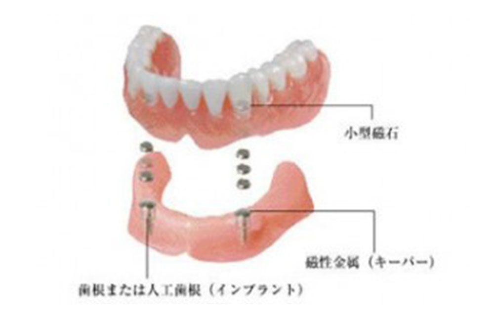 磁力で固定するマグネットデンチャー