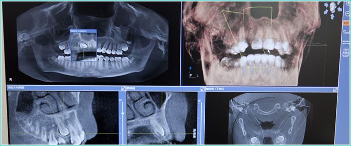 歯科用CTによる精密検査