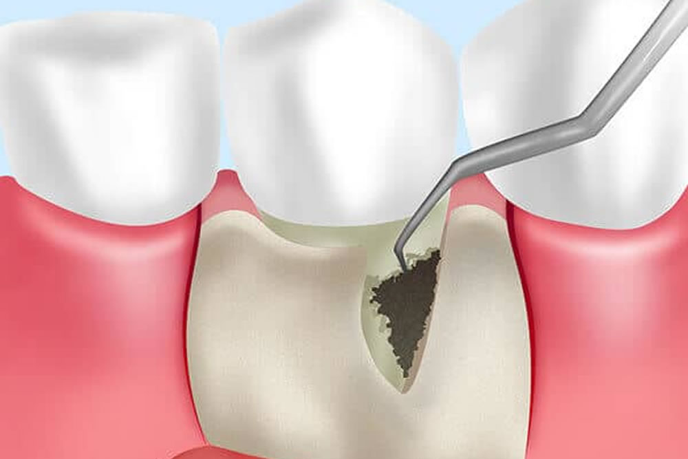 歯周外科治療の実施