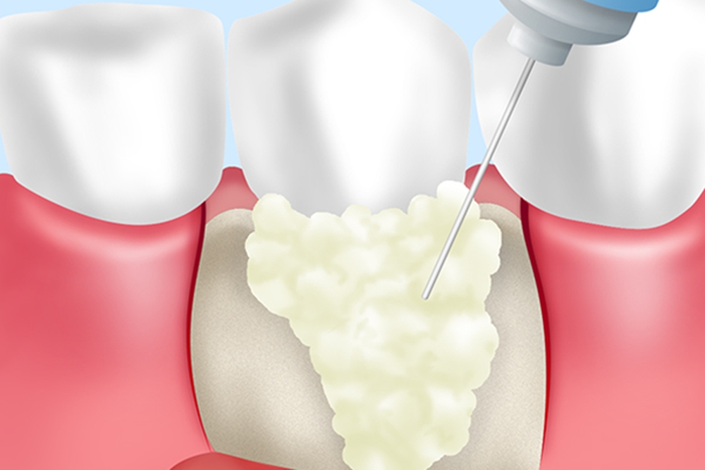 歯周組織再生療法の実施