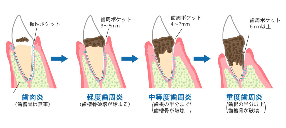 歯周病の基本的な治療方法