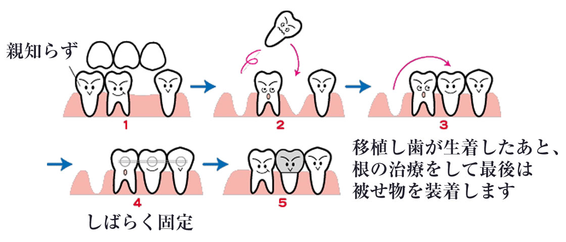 親知らずの移植・再生療法